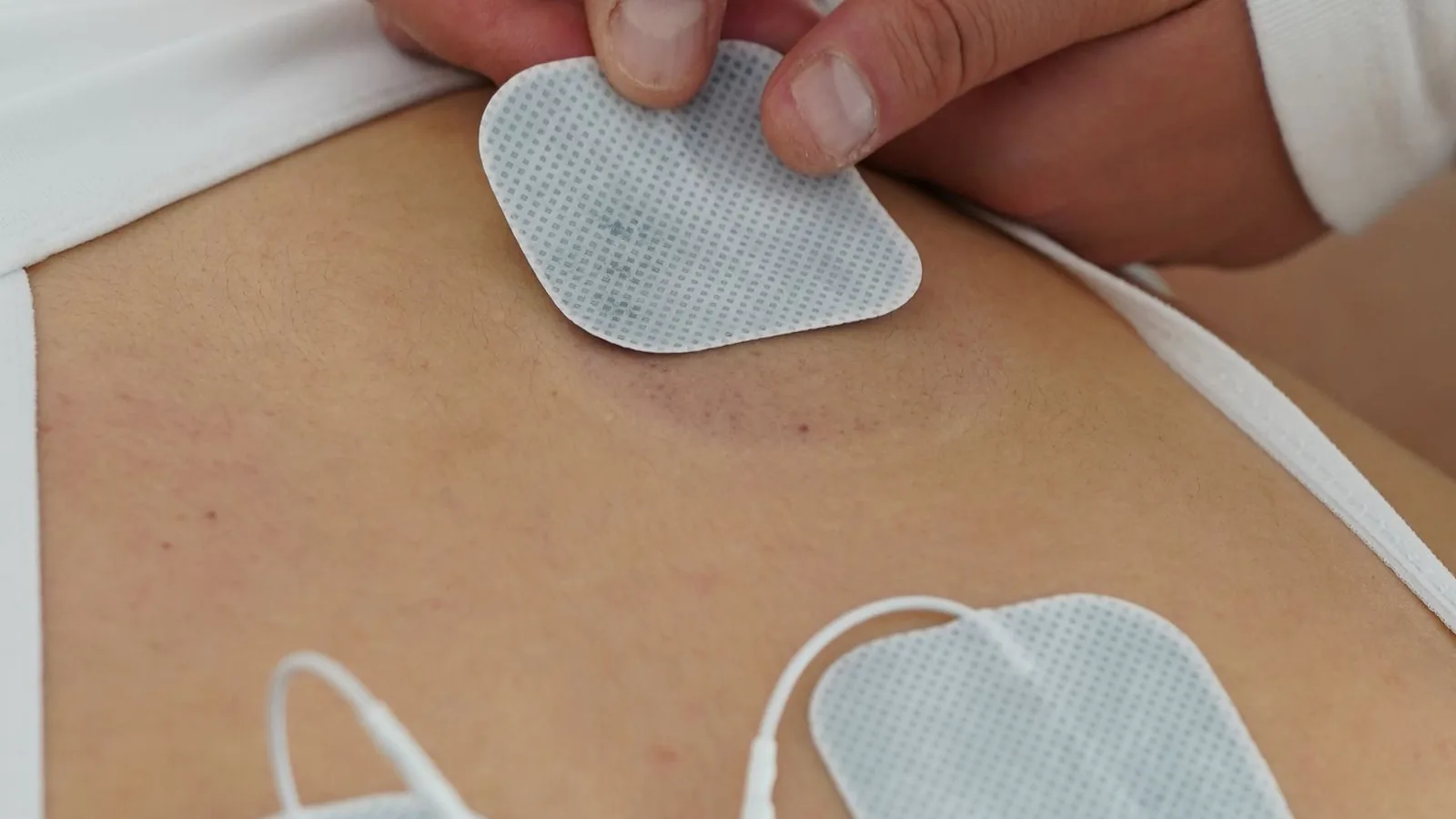 Elektroden werden zur Reizstrombehandlung am Rücken angelegt